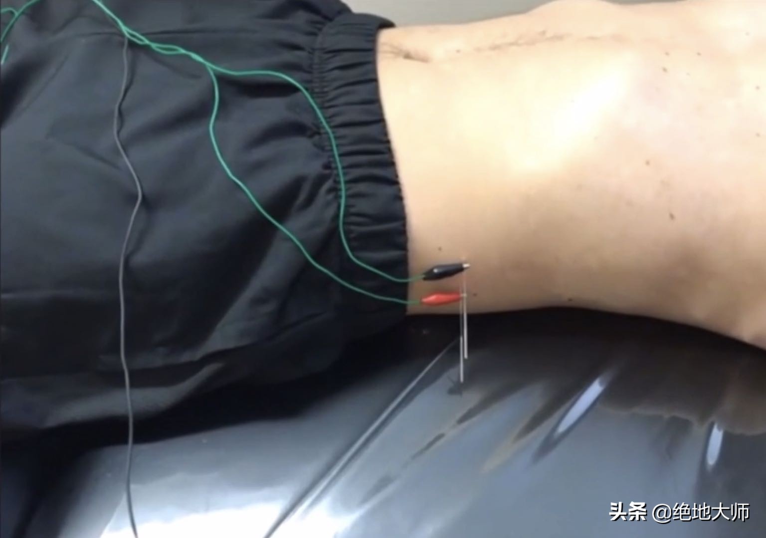 亚急性腰痛康复治疗,急性腰突压迫神经自然恢复要多久