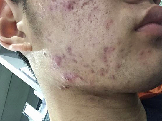 皮肤科医生讲的故事,皮肤科看痘痘痘印