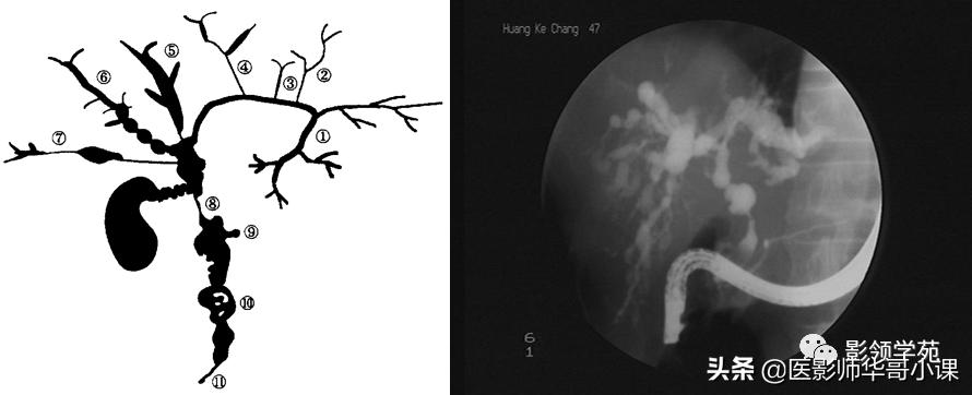 胆总管变异,胆胰管解剖
