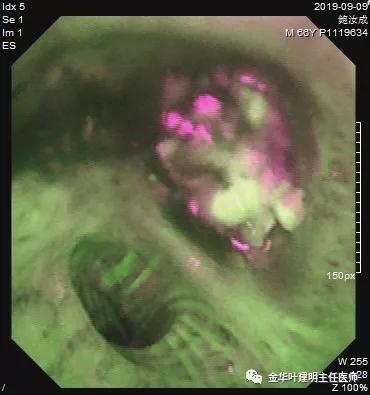 肺癌伴胸腔积液伴膨胀不全,肺癌晚期转移到肝脏引起腹腔积液