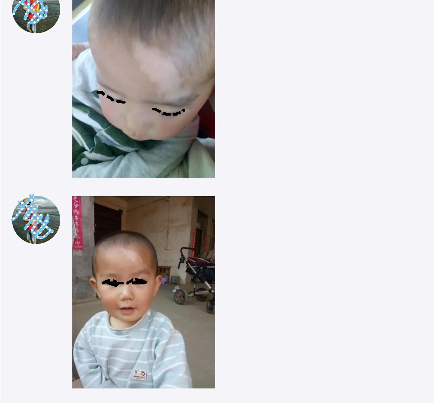 咨询故事：这个孩子额头的白斑是什么病？