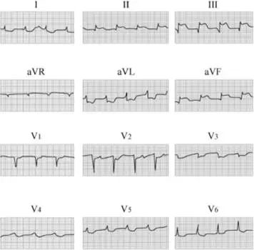 心律失常55分钟讲解,心律失常心电图讲解视频教程全集