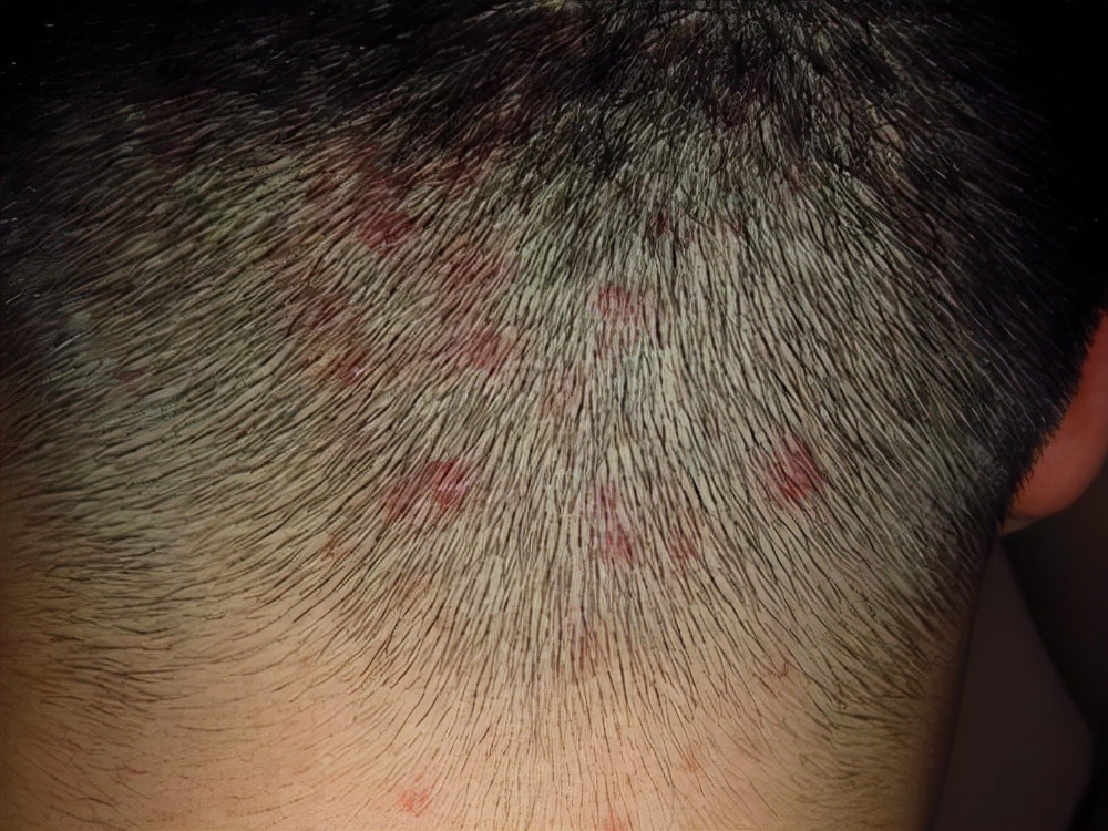 头上密密麻麻小疙瘩是什么,头上摸到肿块是怎么回事