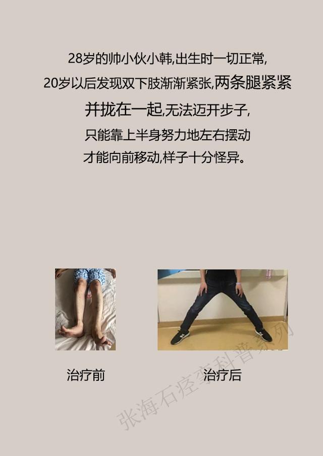 眼睑痉挛如何治疗,痉挛状态如何缓解
