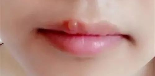 孕晚期嘴角长泡泡,孕期上火嘴里有泡泡应该怎么办