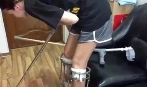 女子要做断骨增高手术,中国首例断骨增高术