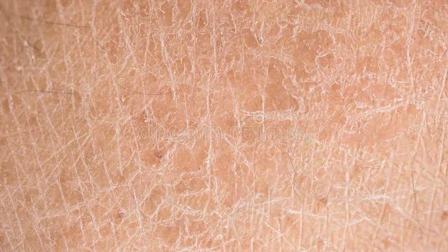 冬天腿上起白皮屑是怎么回事,冬天裤子上很多白色皮屑怎么去除