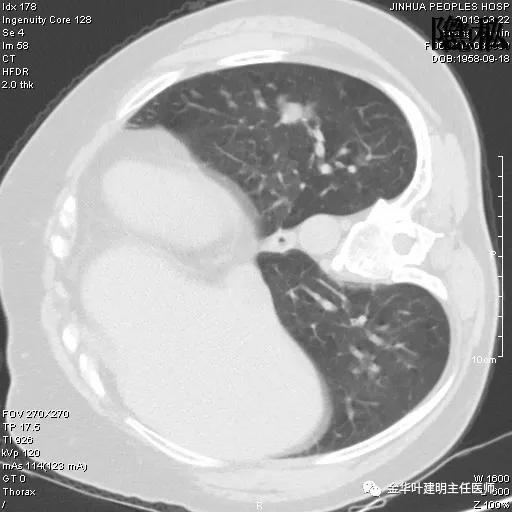 左肺下叶恶性病变,左肺上叶和下叶都有血管畸形