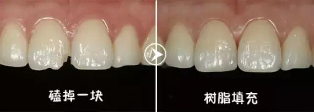 前牙磕掉了一块怎么办？#葉子口腔科普#