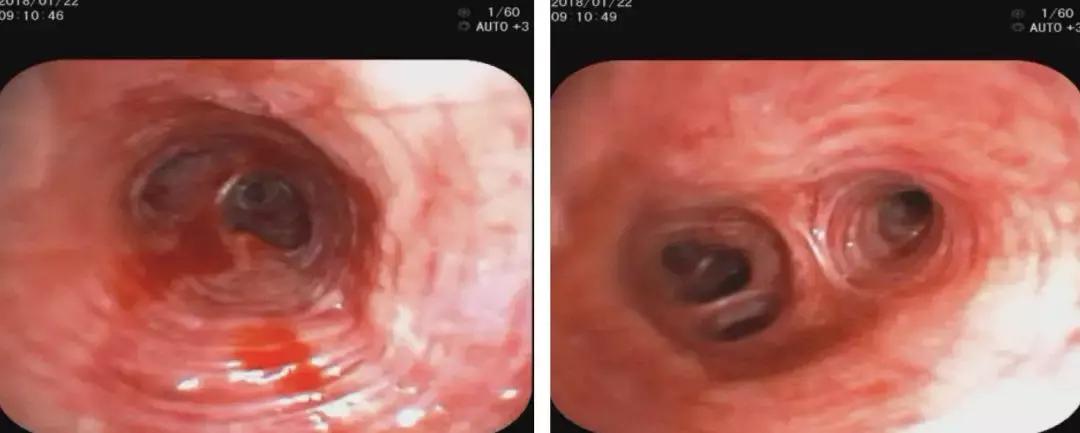 青年男性肺炎过后一直咳嗽怎么办,潜伏结核感染咳嗽咳痰