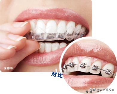 隐形矫正的效果,隐形矫正有微整效果吗