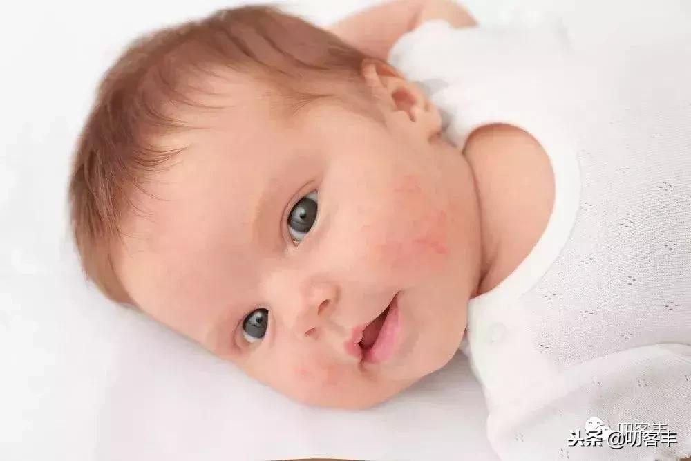 孩子皮肤干裂,孩子皮肤干裂痒怎么办