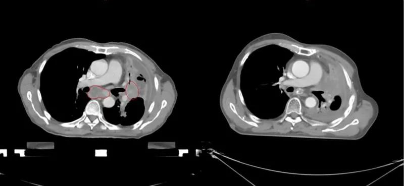 商陆治疗肺癌晚期,硼中子治疗晚期肺癌