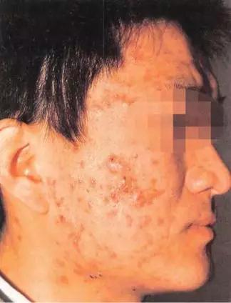 青春痘皮肤病如何治疗好,青春痘怎么治疗最好女学生