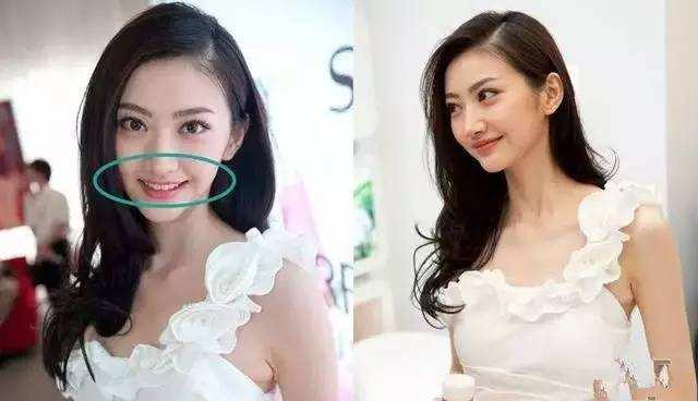 满口全瓷牙的明星李沁,李沁矫正牙齿前的照片