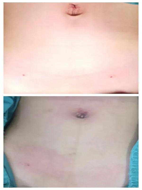 濮阳市油田医院腹腔镜,濮阳油田总医院腹腔镜手术