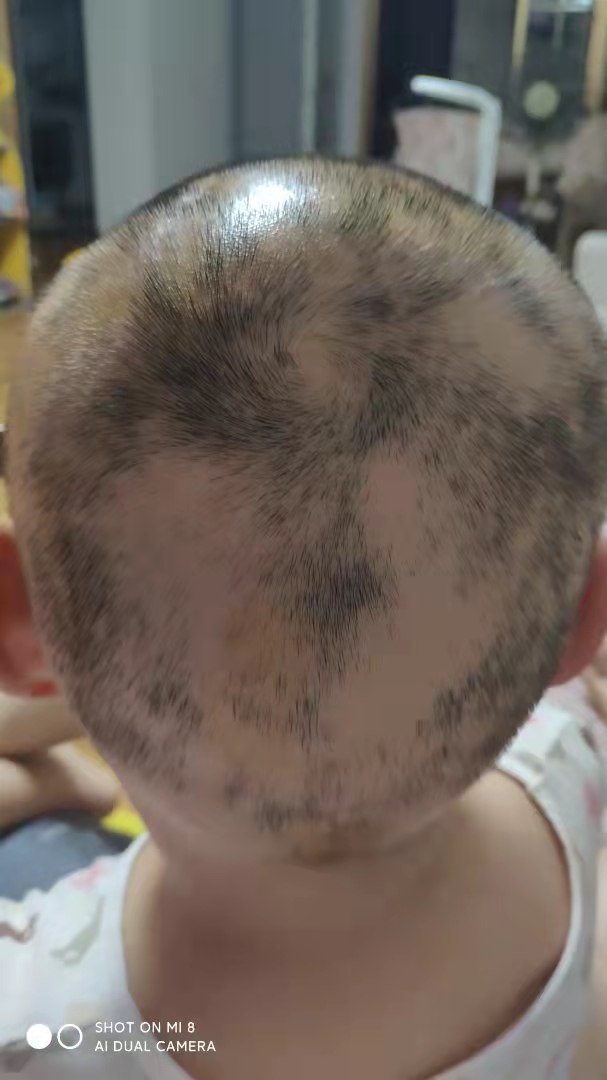 斑秃属于疑难杂症么,斑秃治疗中越来越严重怎么回事