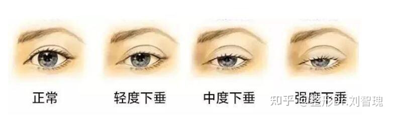 割双眼皮真的有必要吗,有必要割双眼皮吗