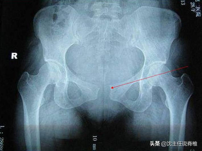 困扰产后妈妈的耻骨痛，该怎么办？