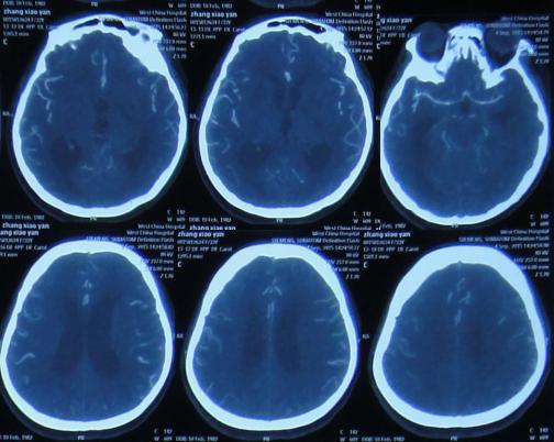 结核性脑积水,脑膜炎脑积水要治疗多久