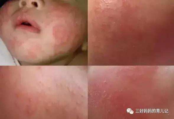 幼儿急疹和痱子怎么区分,宝宝急疹和痱子的区别