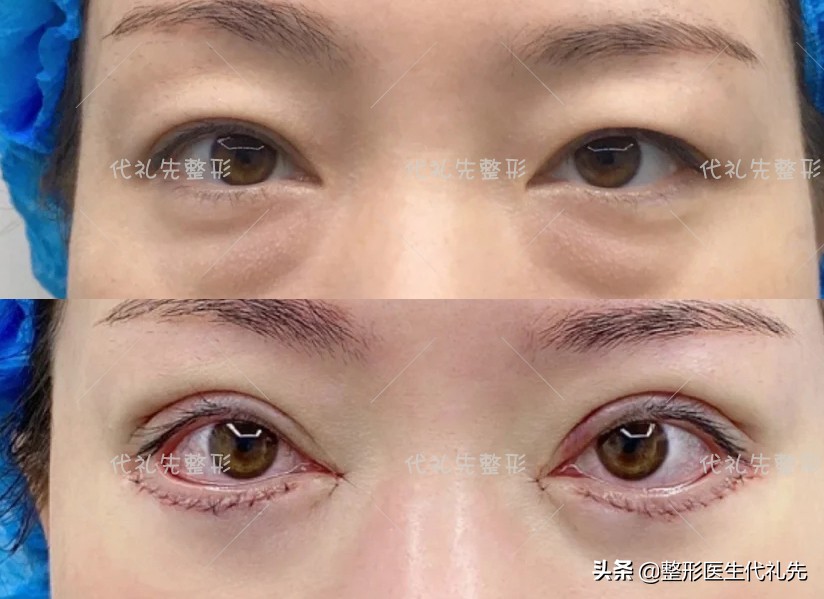 内路法祛眼袋手术效果能保持多久,去眼袋手术警惕三大后遗症