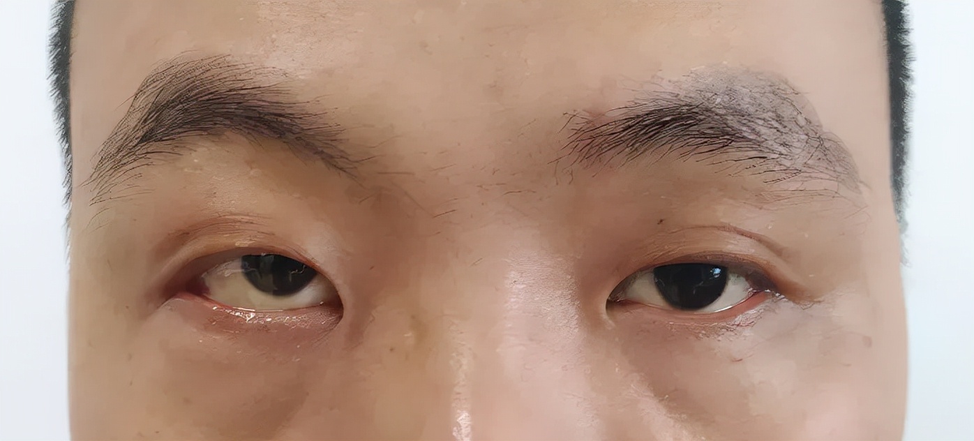 男子眼睛突出，周太平医生从他眼眶里取出一个2.5公分的肿瘤