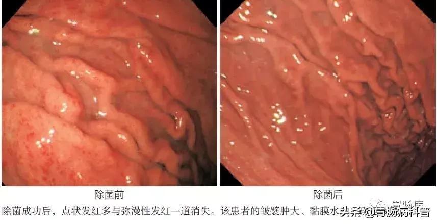 慢性浅表性非萎缩性胃窦炎,浅表性胃炎与慢性非萎缩性的区别