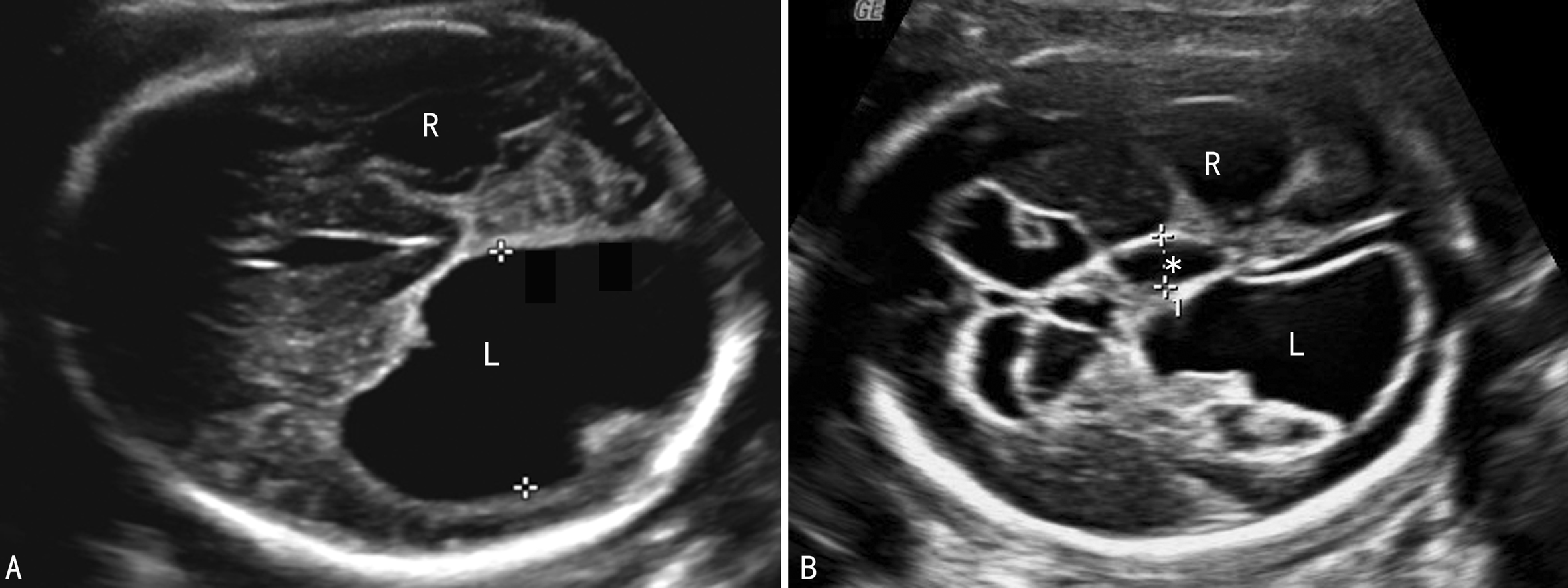 胎儿脑积水的超声图像,胎儿脑积水25m超声图