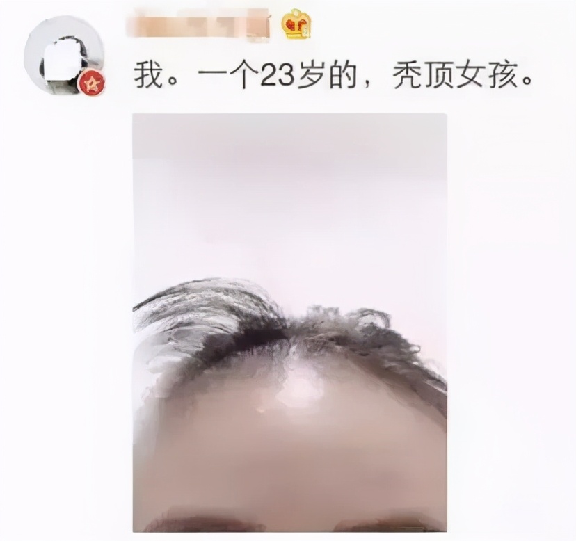 如果你没有头发你一定很秃,不管你的头顶有多秃