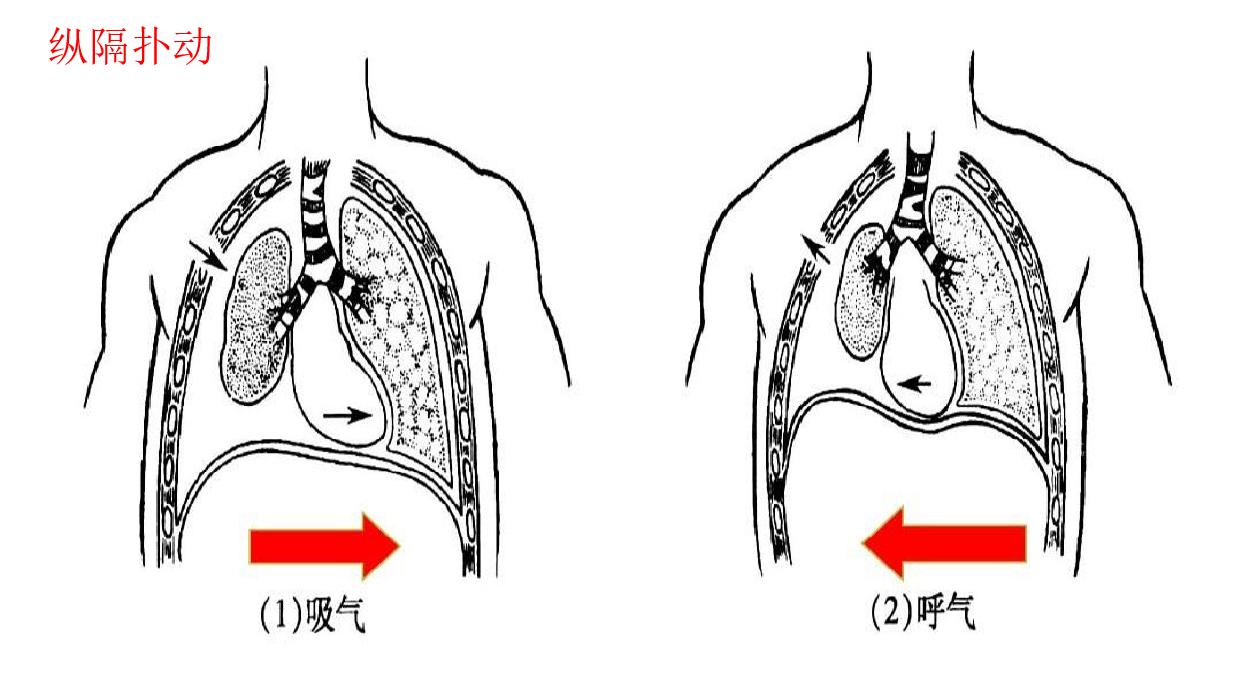 胸外科医生科普:血胸病人的护理措施,值得我们一看,很有用