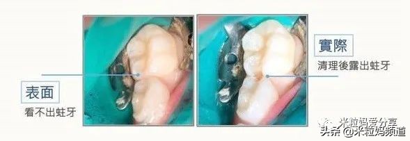 小朋友的蛀牙是怎么形成的,10岁小孩有7颗蛀牙