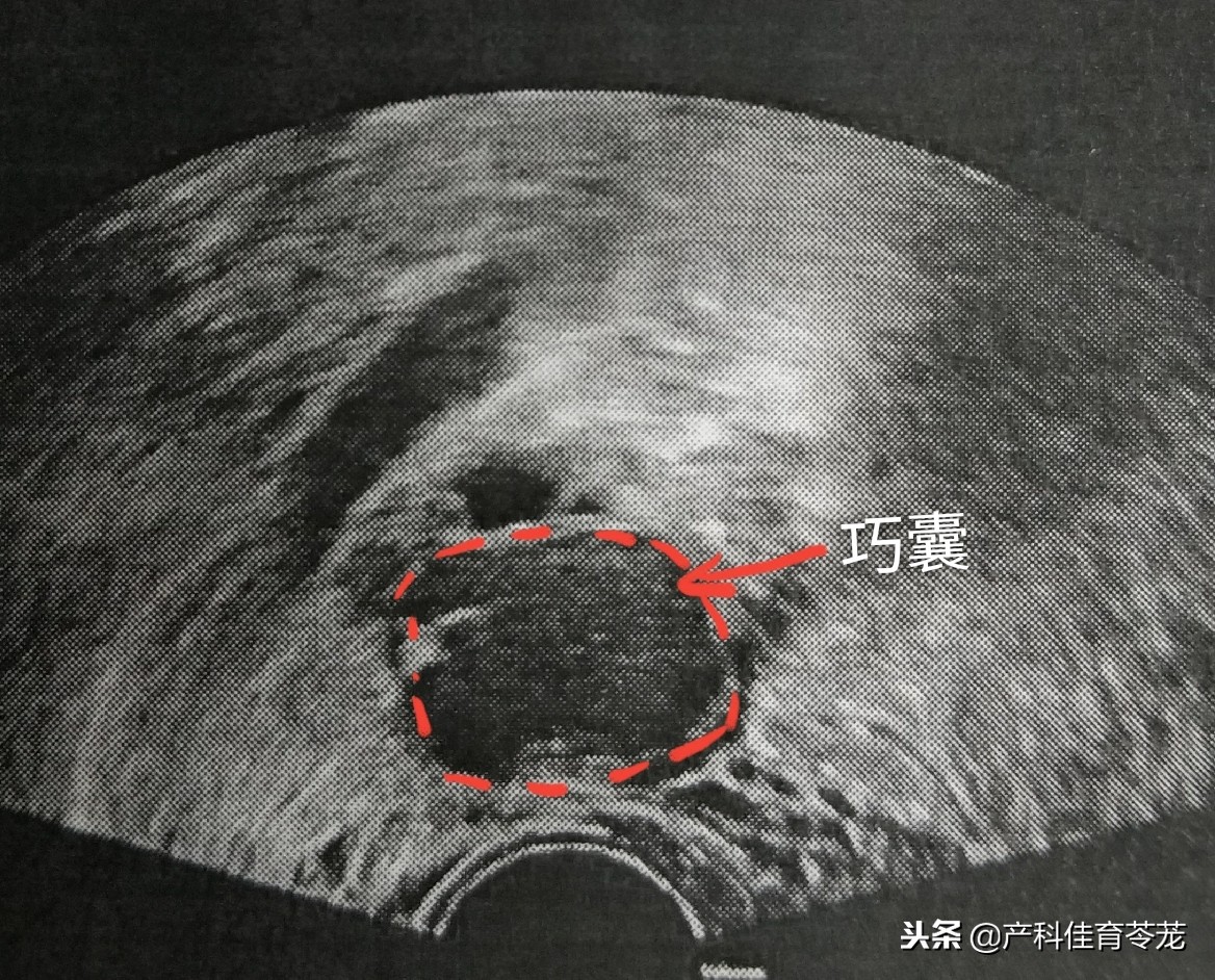 卵巢囊肿是黄体囊肿吗,盆腔囊肿是卵巢囊肿吗