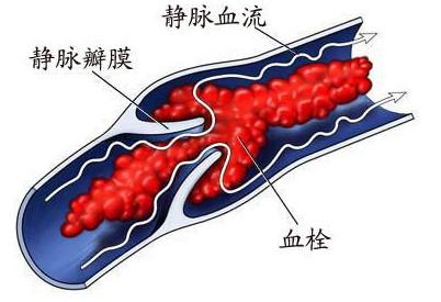 关节置换术后周围胀怎么办,关节置换后一直流水怎么办