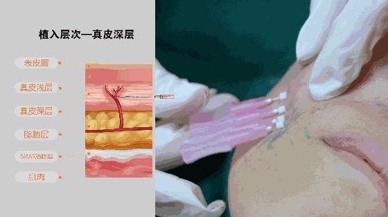 抗衰线雕面部提升多久做一次,无针线雕局部抗衰