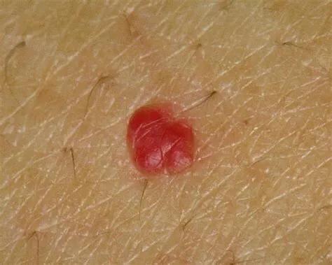 乙肝患者皮肤发黄还意味着什么,乙肝患者皮肤出现红点