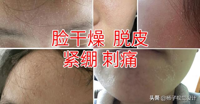脸干燥起皮刺痛紧绷怎样快点能好,脸过敏干燥脱皮紧绷长痘怎么补水