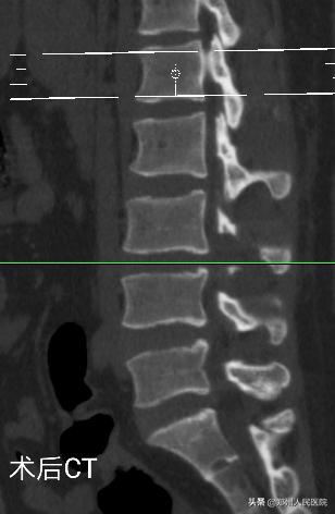 对骨科微创技术的认识,骨科手术与保守治疗对比