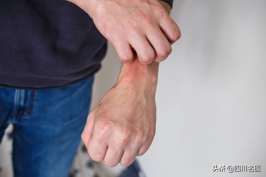 银屑病全身红疹,银屑病红疹越多越容易好