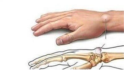 手上无缘无故多了个包，如何是好？