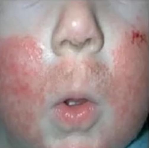 宝宝脸上湿疹破皮反复,宝宝脸上结黄痂是什么