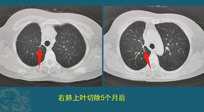 听诊器能听出早期肺癌吗,医生听诊器能听出肺癌吗
