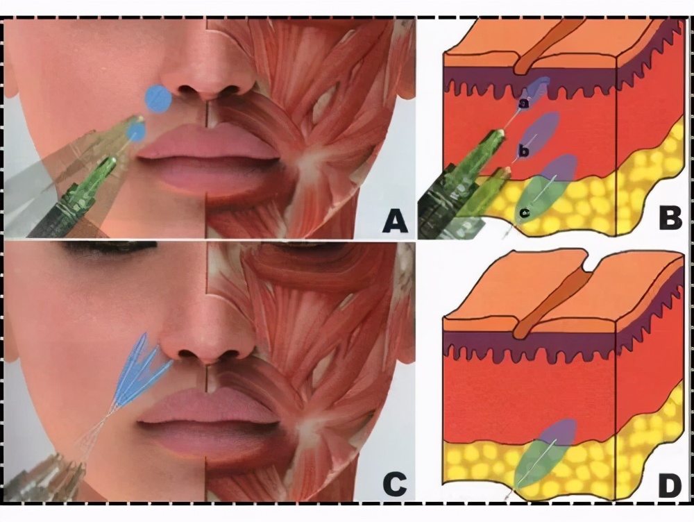 法令纹是什么怎么改善,为什么会有法令纹怎样才能消除