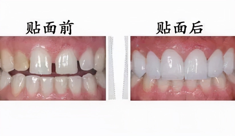 牙齿美白去黄的最快方法,什么牙膏美白牙齿去黄最好