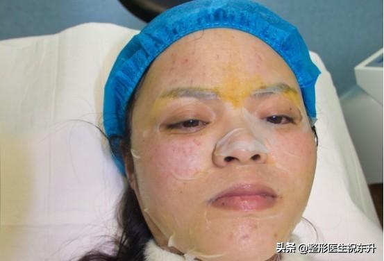 打水光针真实感受,打水光针好的评价