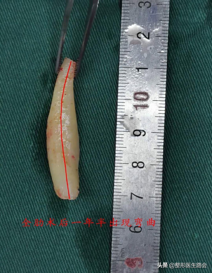 为什么耳软骨只能垫鼻尖不能隆鼻,肋软骨隆鼻时间久了会顶破鼻尖吗