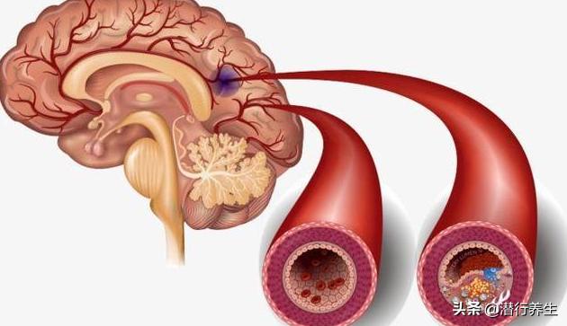 62岁男子突发脑梗52分钟紧急溶栓,一男子突发脑梗送医
