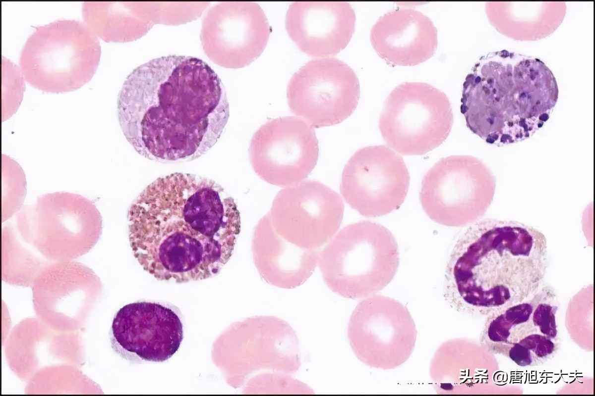 血常规白细胞和淋巴细胞低是什么意思,孩子血常规白细胞20以上严重吗