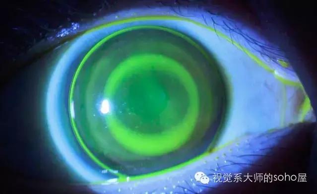 如何选择角膜塑形镜的品牌,怎么选角膜塑形镜的参数