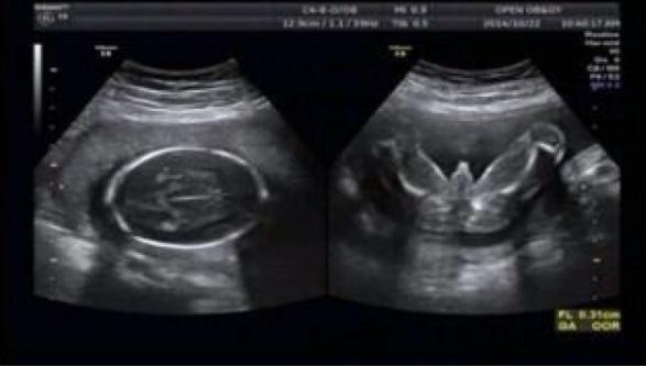 孕妇做b超胎儿在开车视频,b超胎儿开车